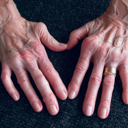 Artritis en las manos, dolor e inflamación